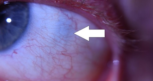Očné bielko - degeneratívne zmeny Očná diagnostika z očného bielka